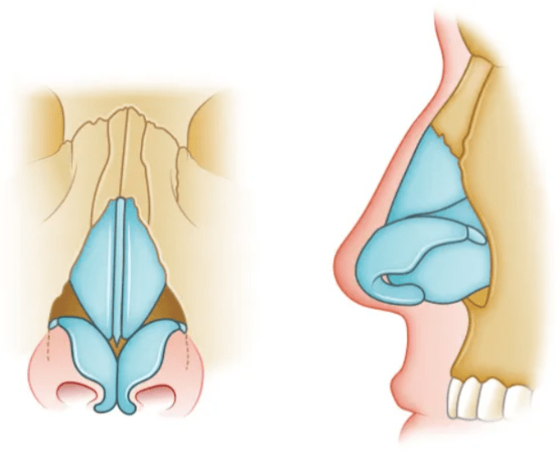 Nasal Fracture